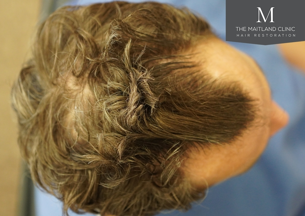 1030 grafts by FUE
