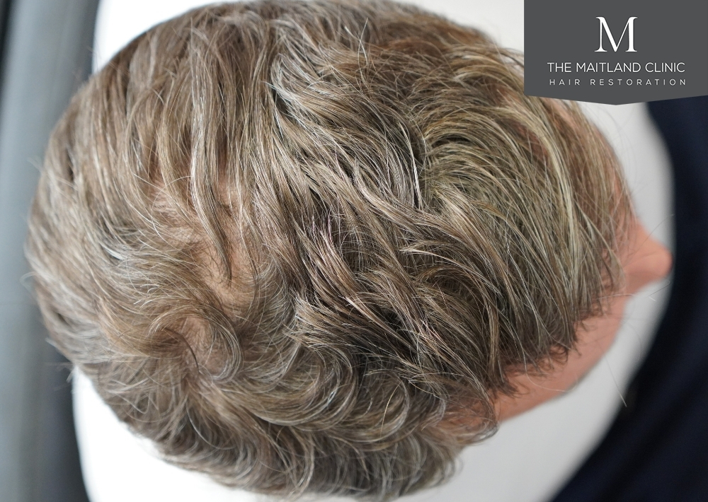1030 grafts by FUE