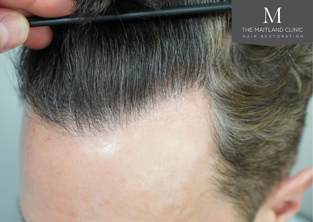 1786 grafts by FUE
