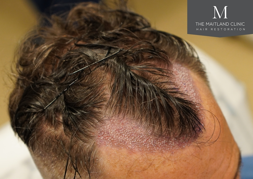 1030 grafts by FUE