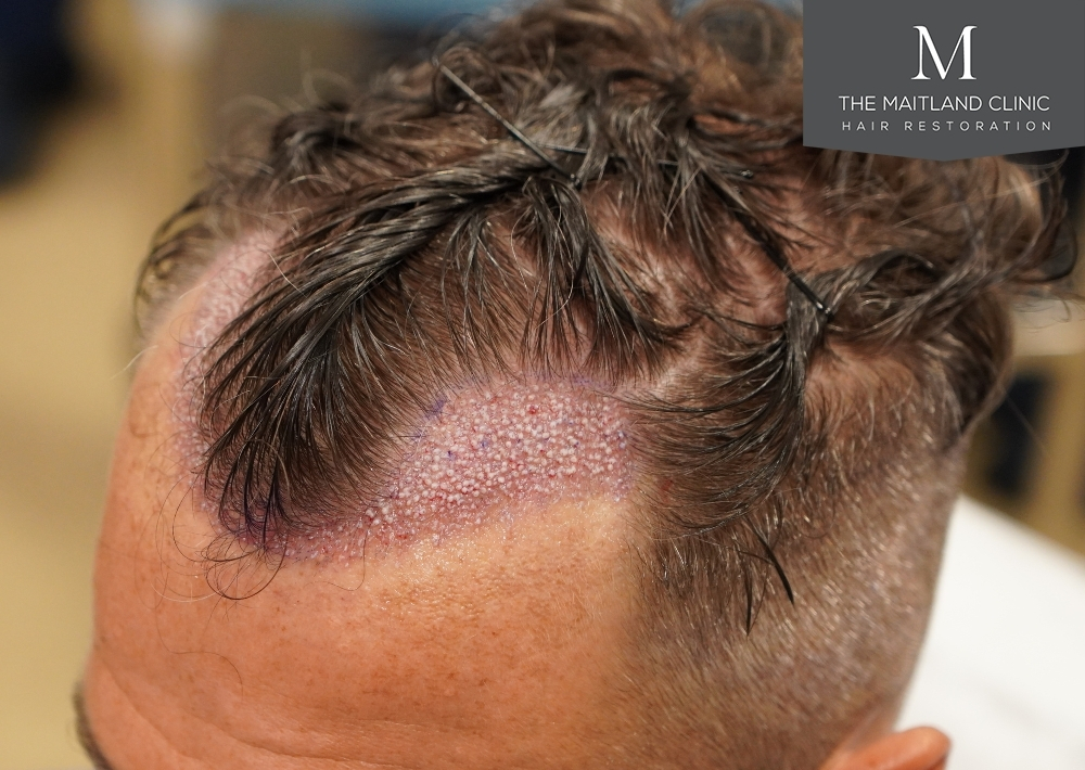 1030 grafts by FUE