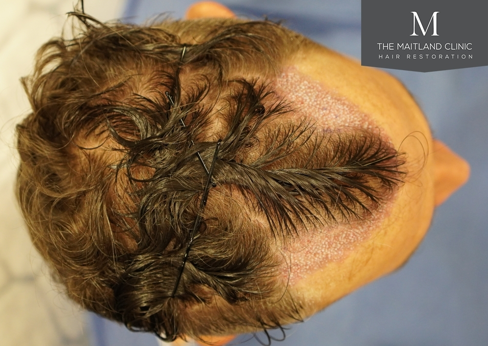 1030 grafts by FUE
