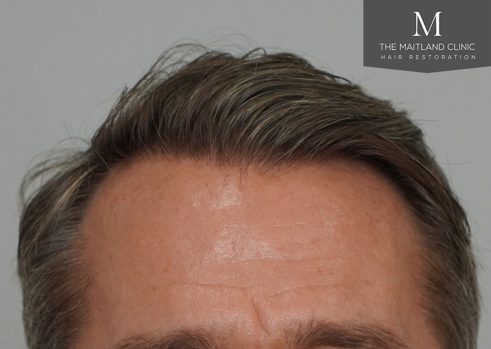 1030 grafts by FUE