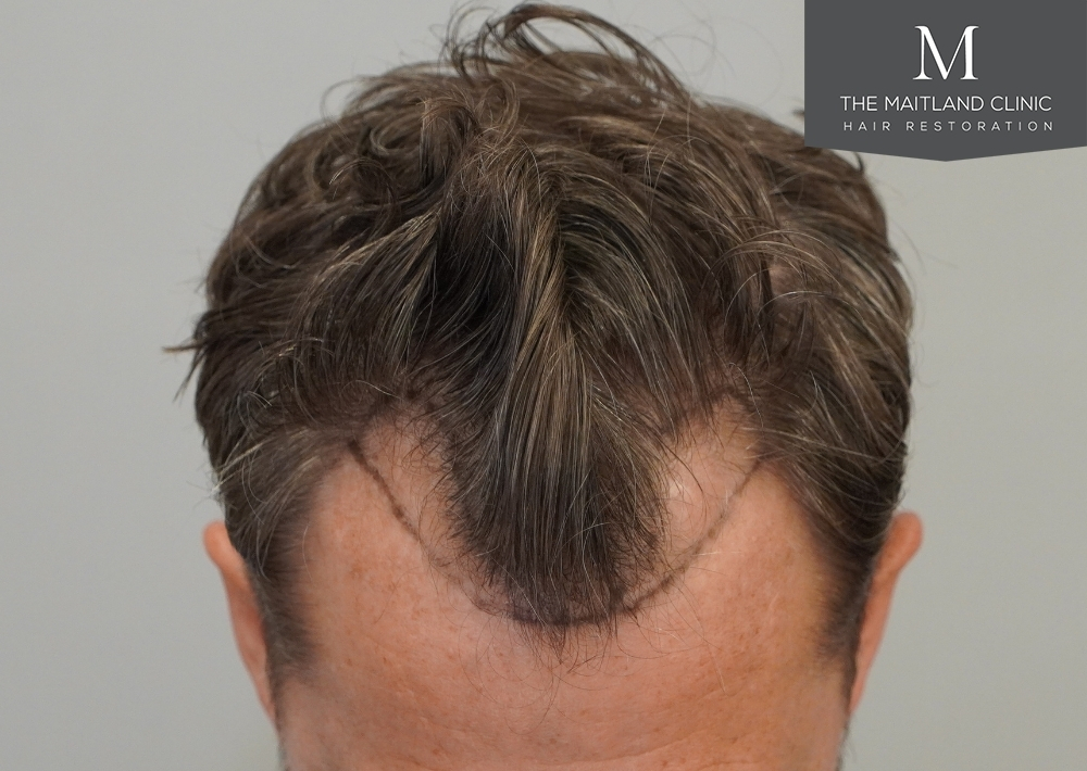 1030 grafts by FUE