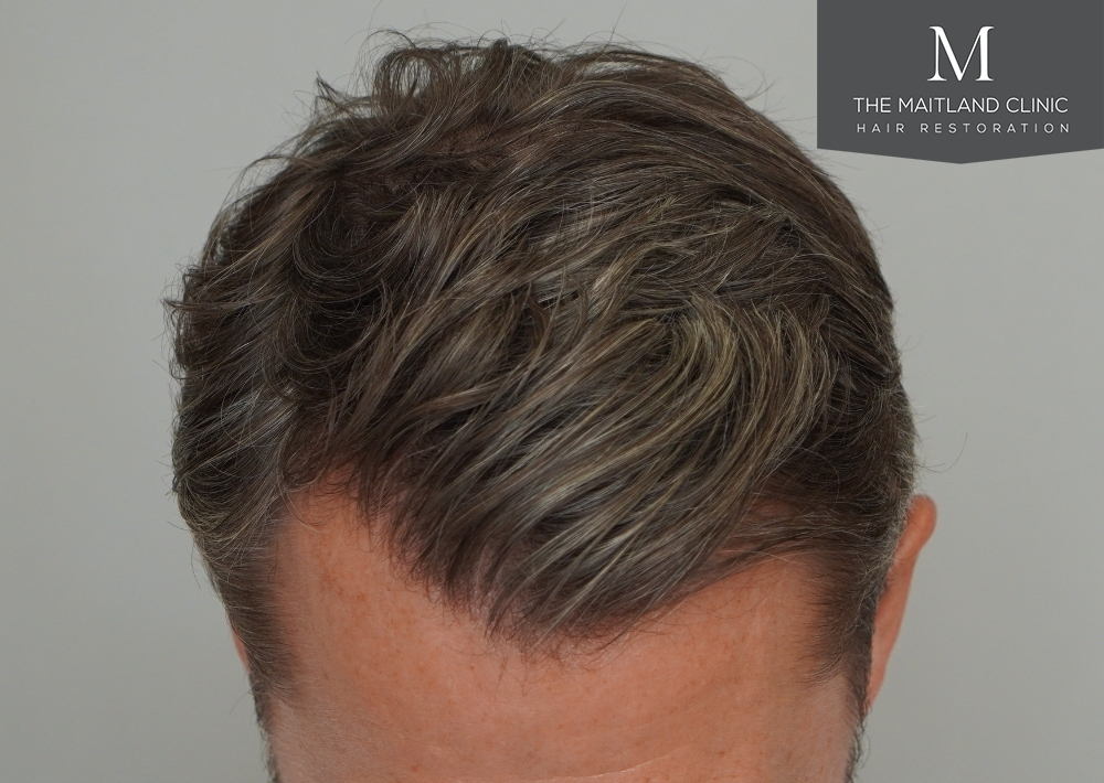 1030 grafts by FUE
