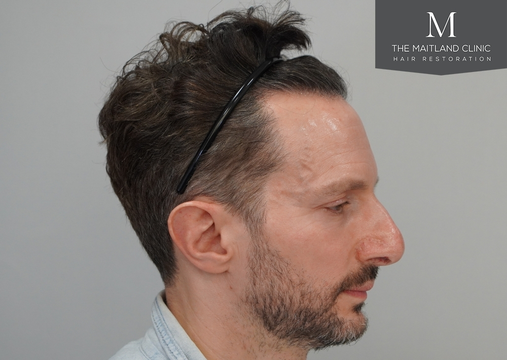1786 grafts by FUE