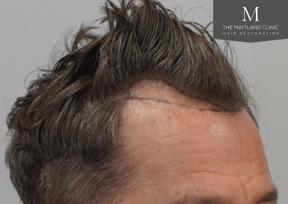 1030 grafts by FUE