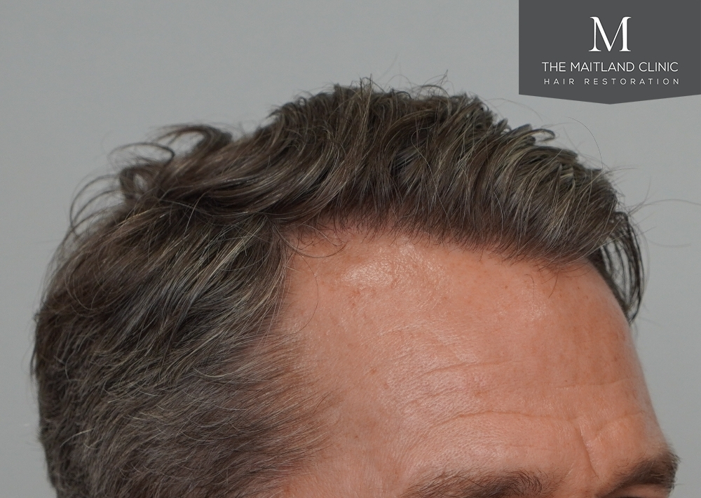 1030 grafts by FUE