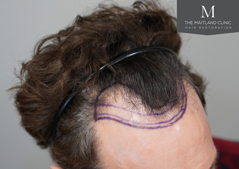 1786 grafts by FUE