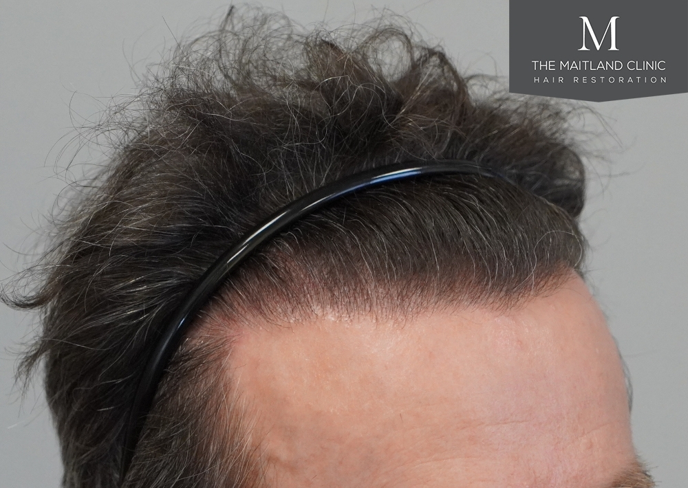 1694 grafts by FUE