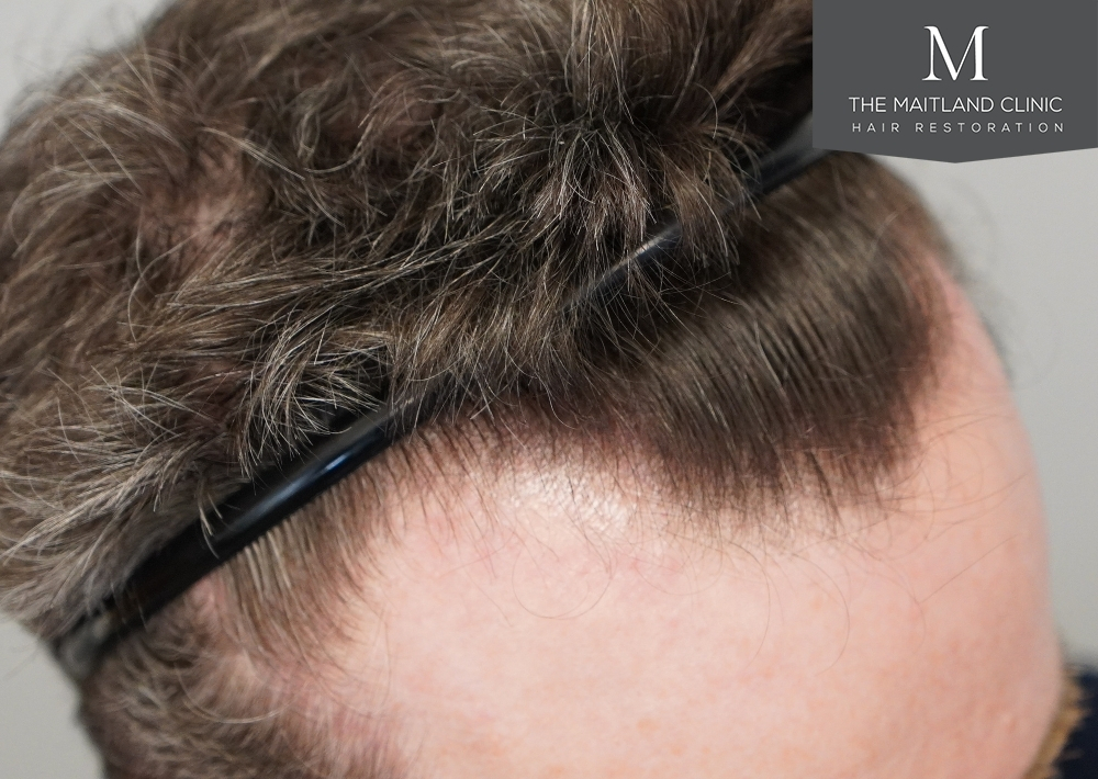 1694 grafts by FUE