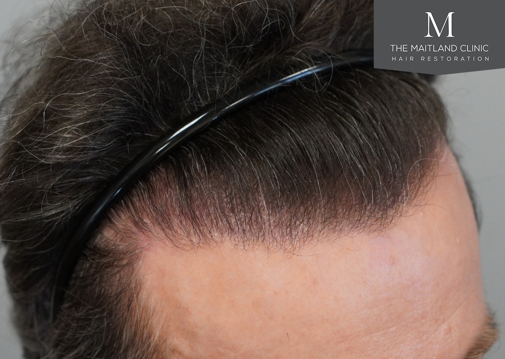 1694 grafts by FUE