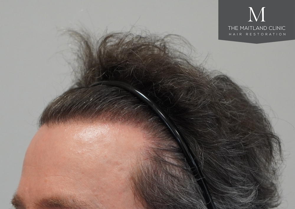 1694 grafts by FUE