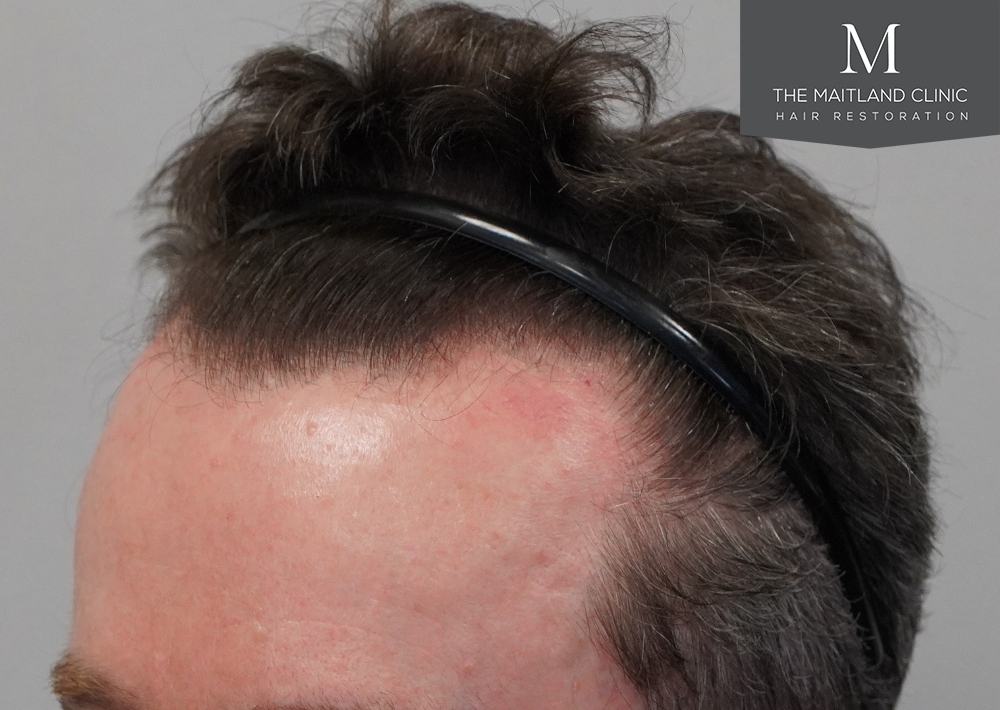 1694 grafts by FUE
