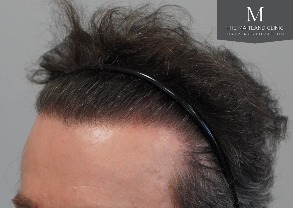 1694 grafts by FUE