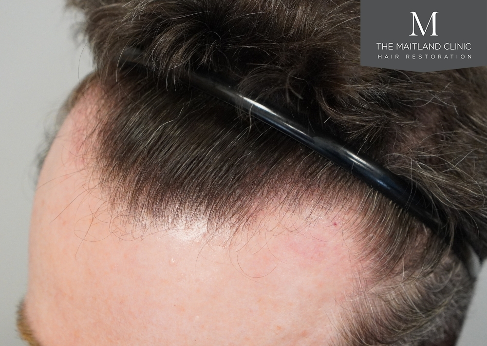 1694 grafts by FUE