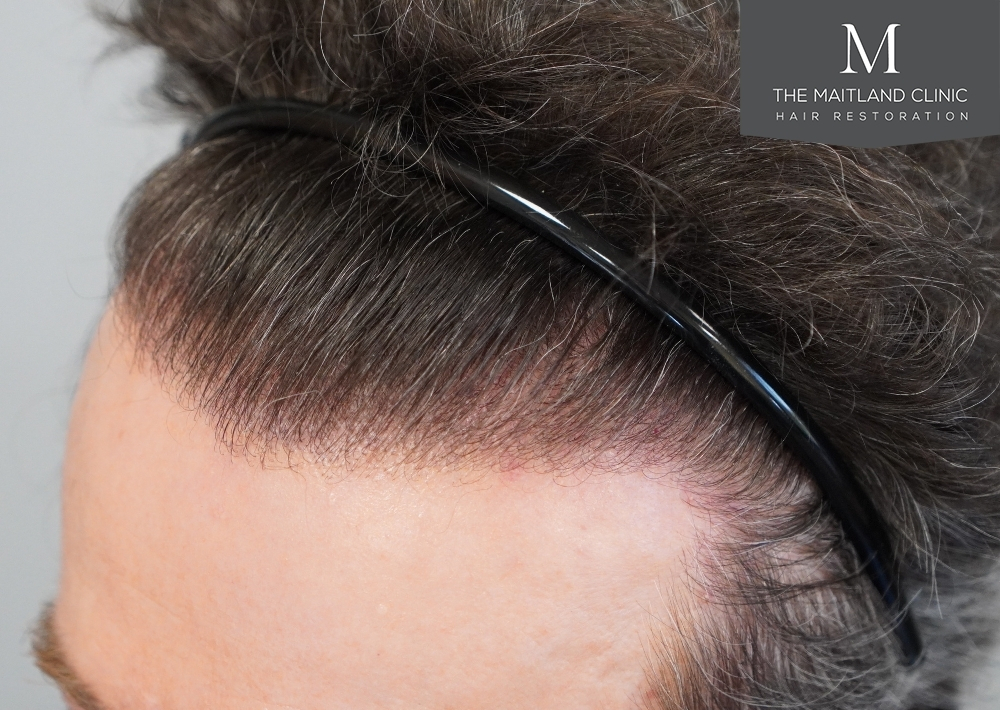 1694 grafts by FUE