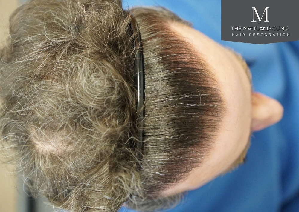 1694 grafts by FUE