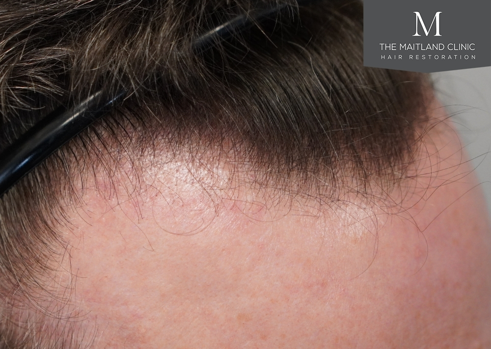 1694 grafts by FUE