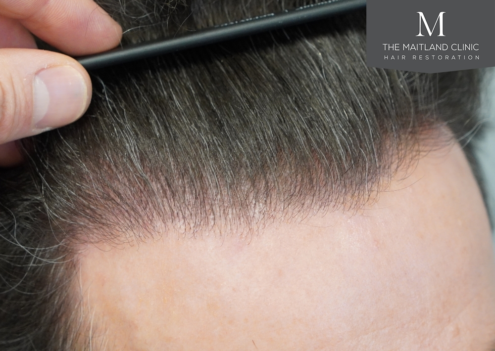 1694 grafts by FUE
