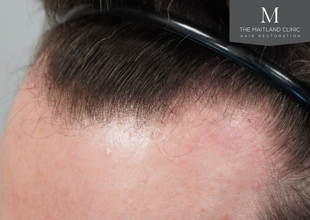 1694 grafts by FUE