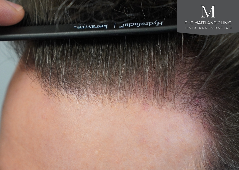1694 grafts by FUE