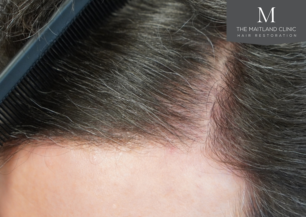 1694 grafts by FUE