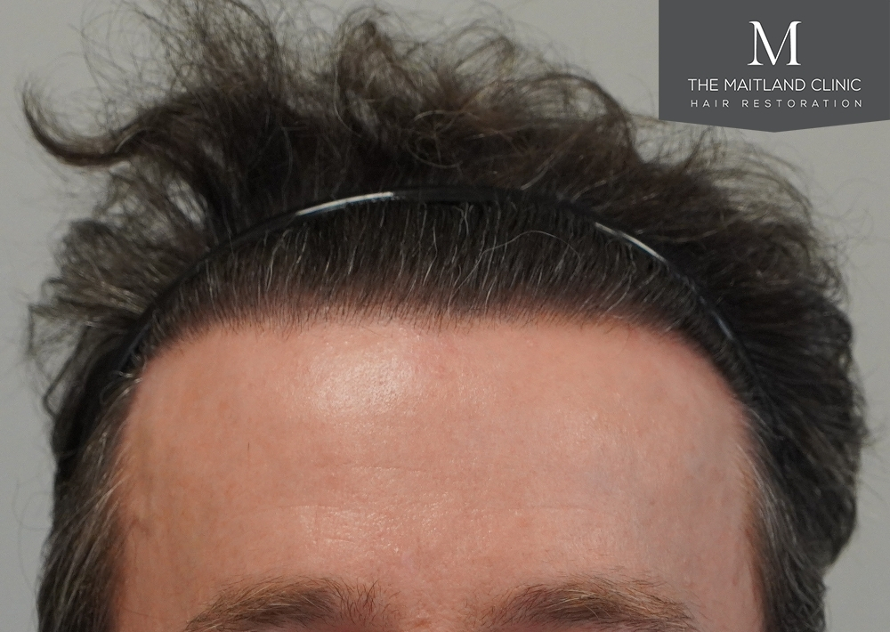 1694 grafts by FUE