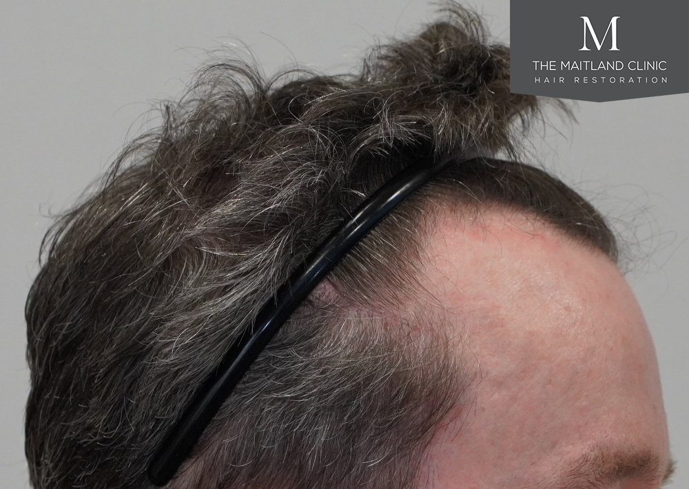 1694 grafts by FUE