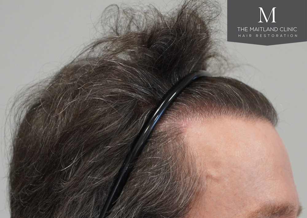 1694 grafts by FUE