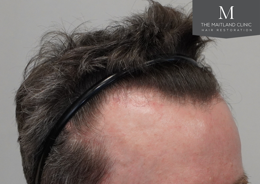 1694 grafts by FUE