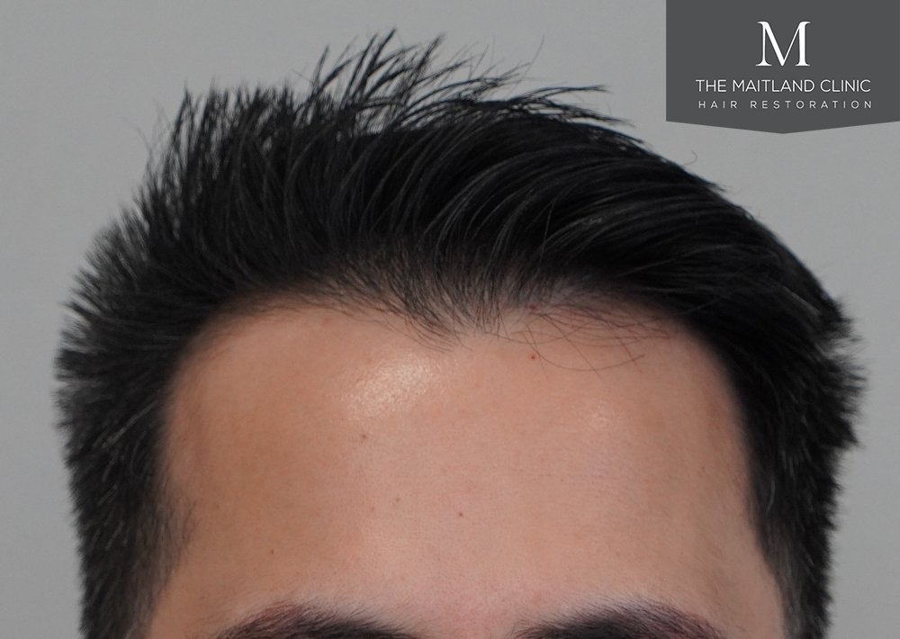 1186 grafts by FUE