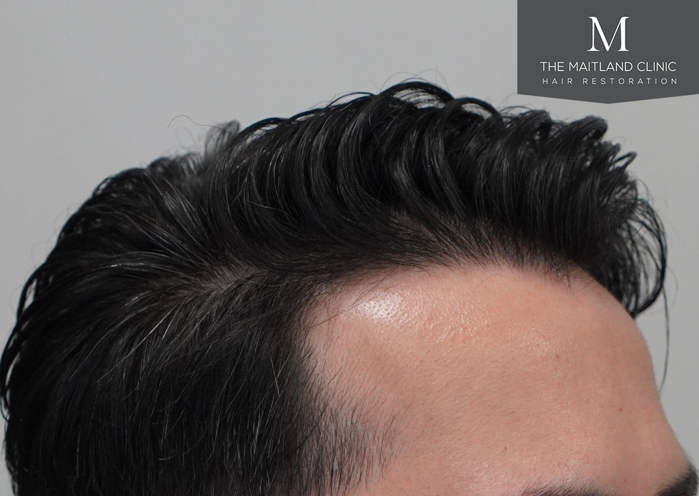 1186 grafts by FUE