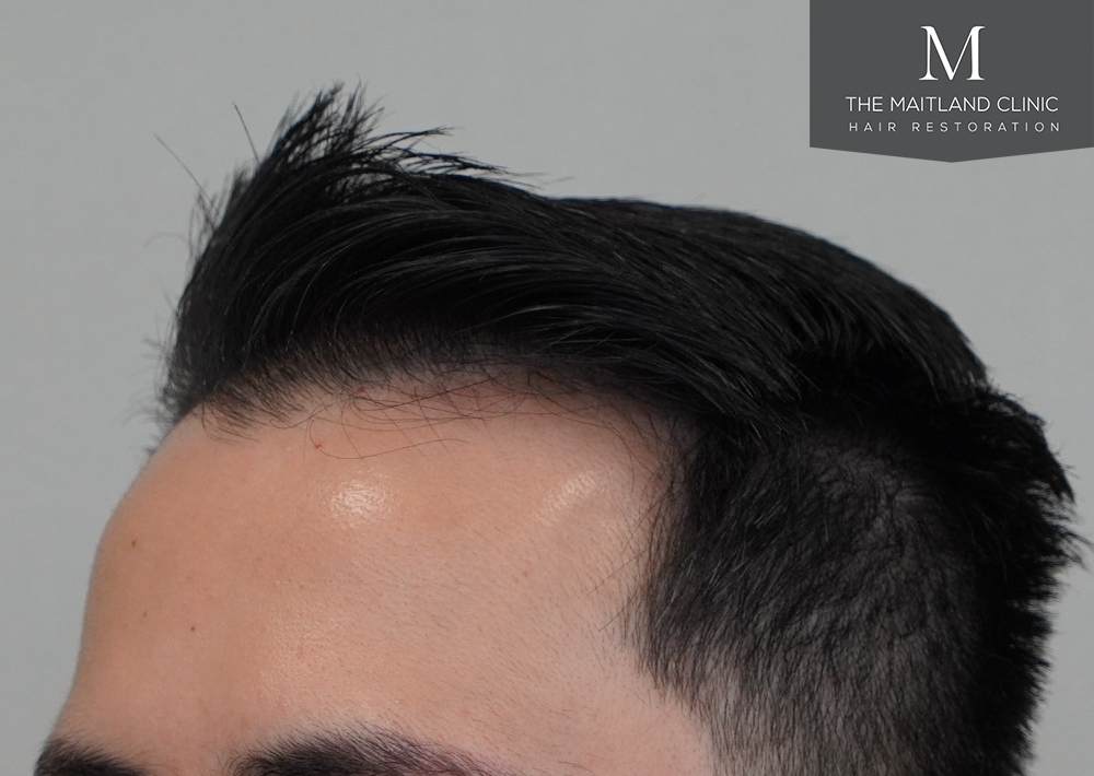 1186 grafts by FUE