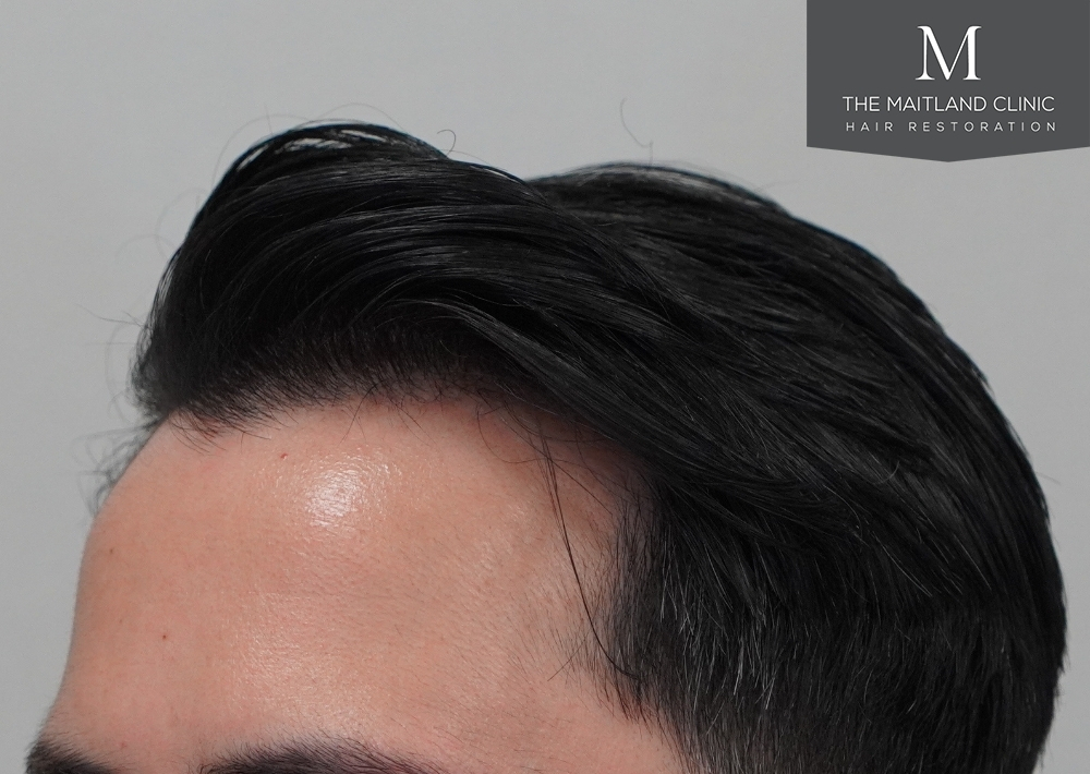 1186 grafts by FUE