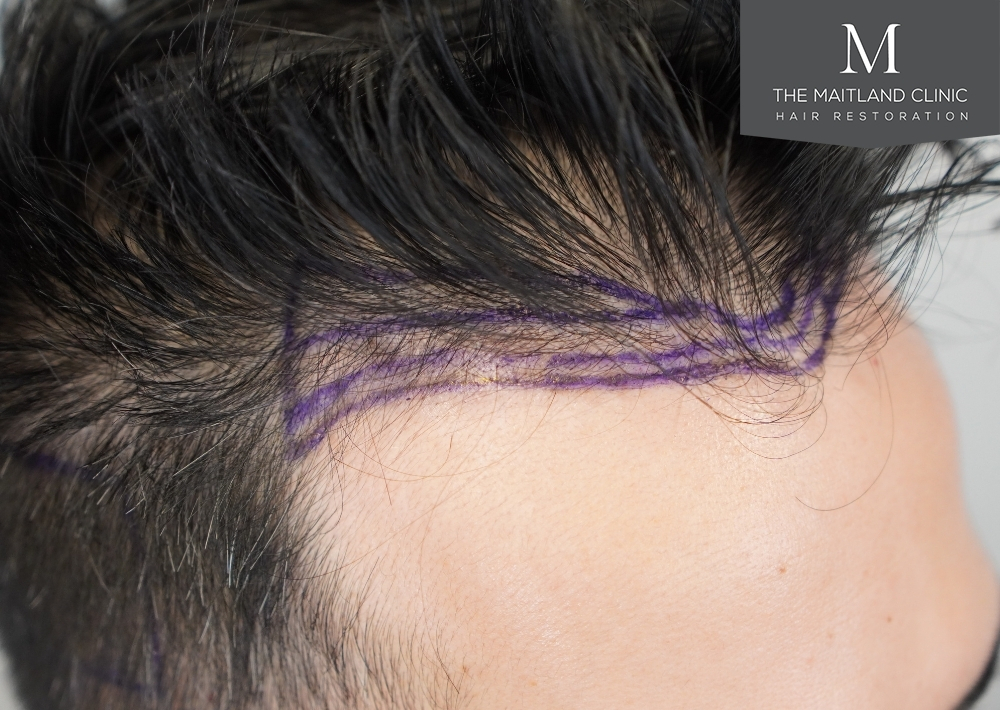 1186 grafts by FUE