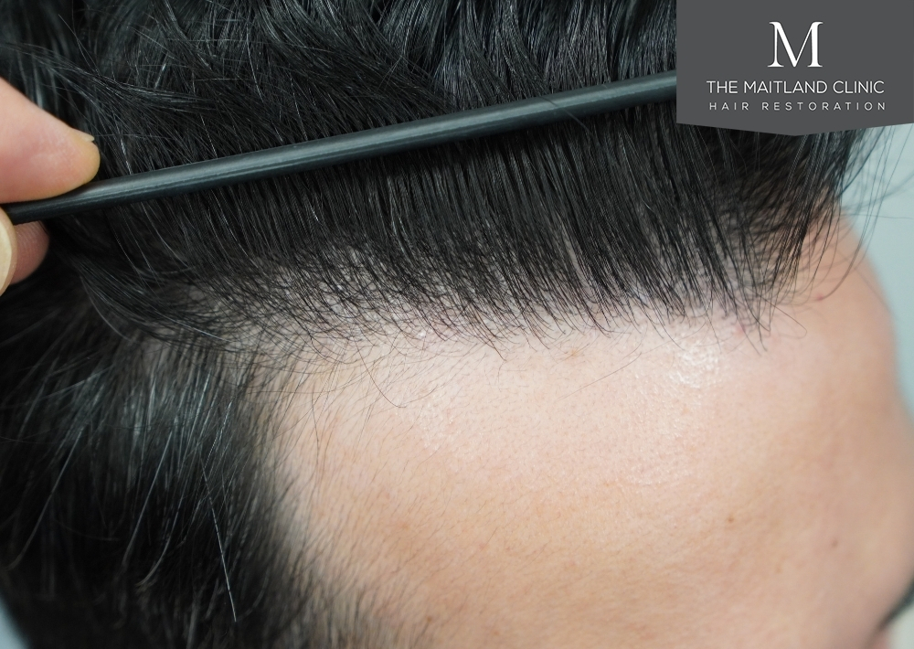 1186 grafts by FUE