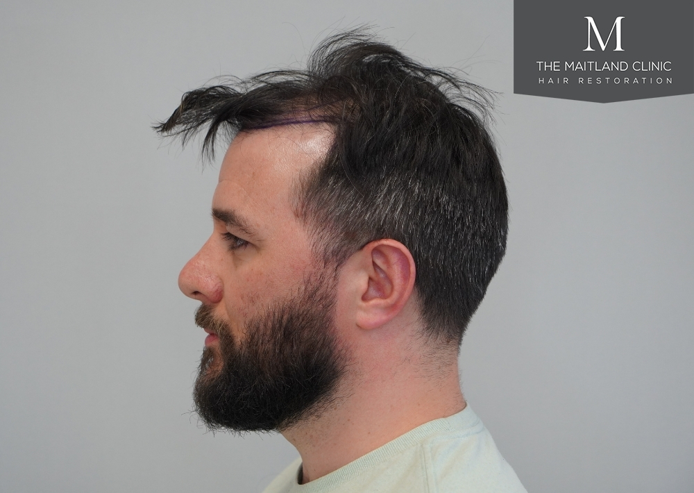 2115 grafts by FUE