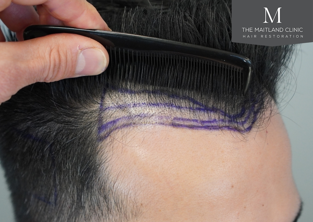 1186 grafts by FUE