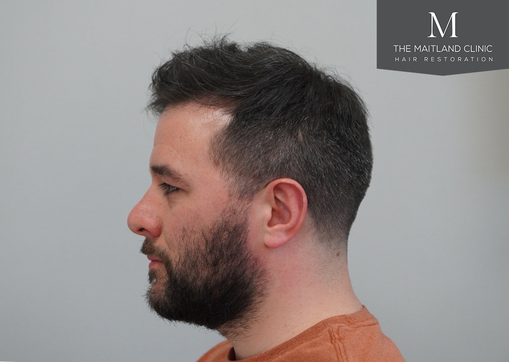 2115 grafts by FUE