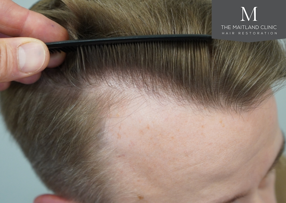 1803 grafts by FUE