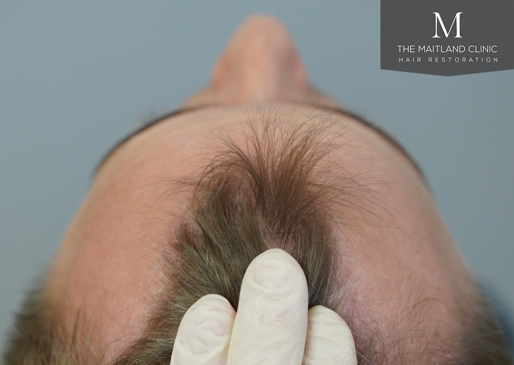 1803 grafts by FUE