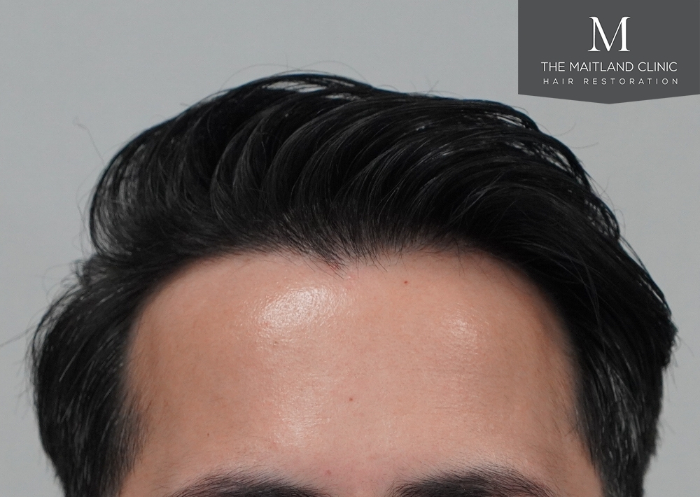 1186 grafts by FUE