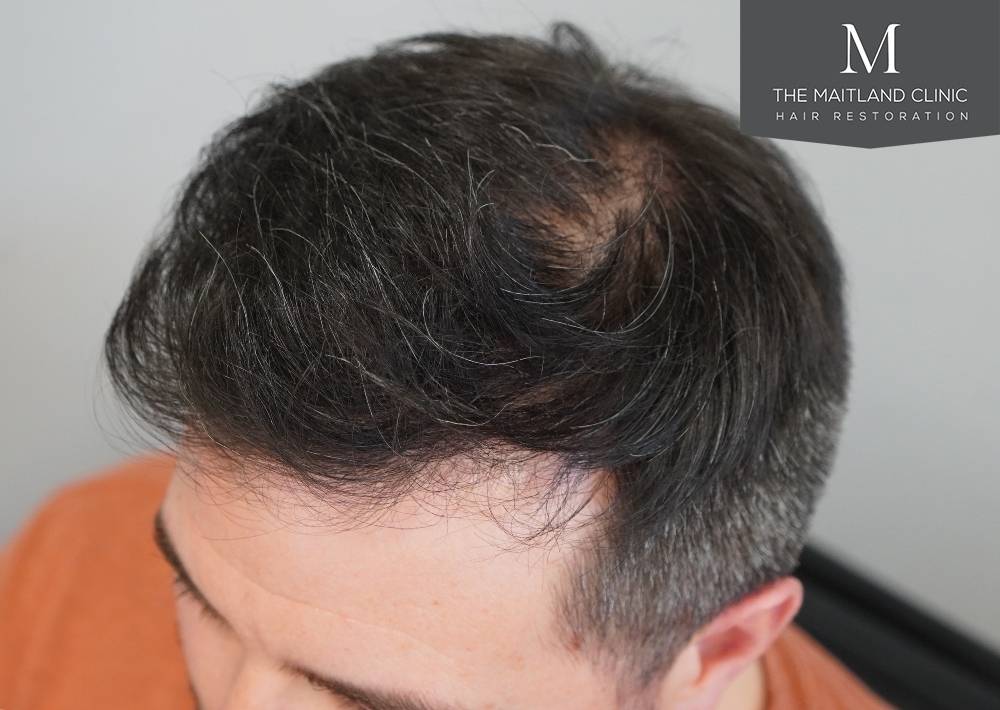2115 grafts by FUE