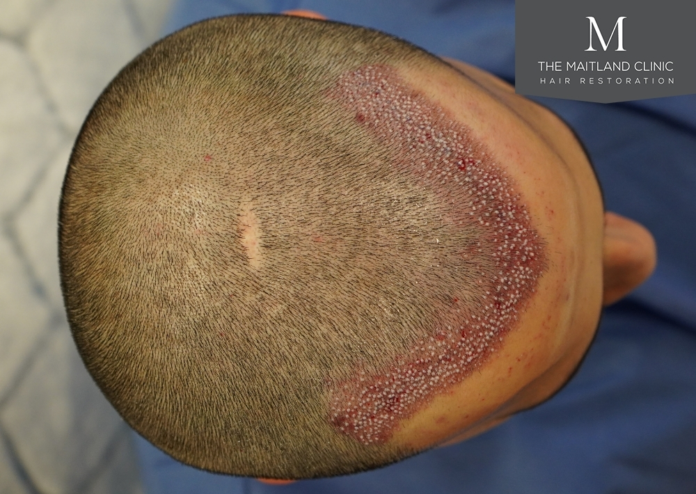 1186 grafts by FUE