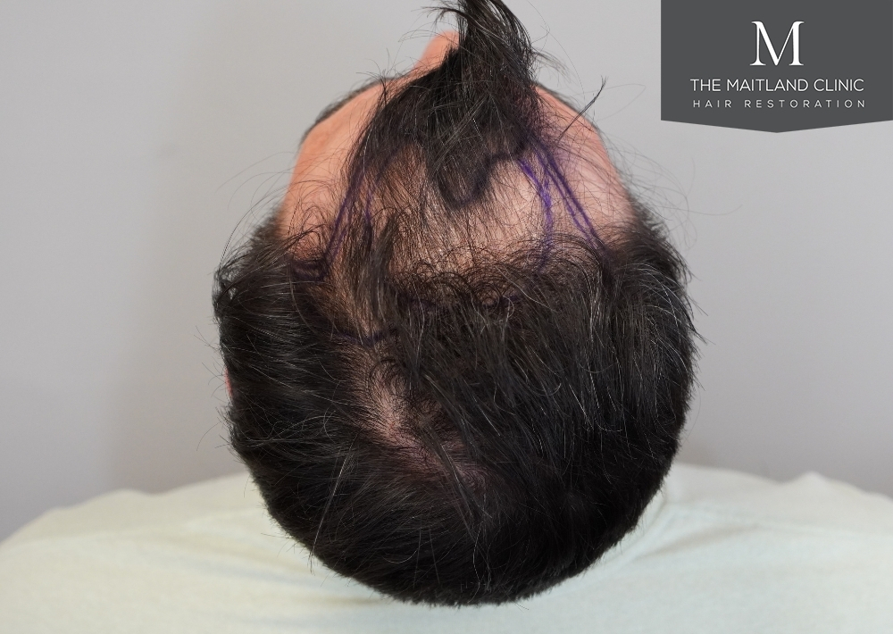 2115 grafts by FUE