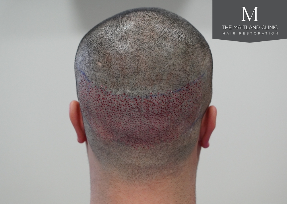 1186 grafts by FUE