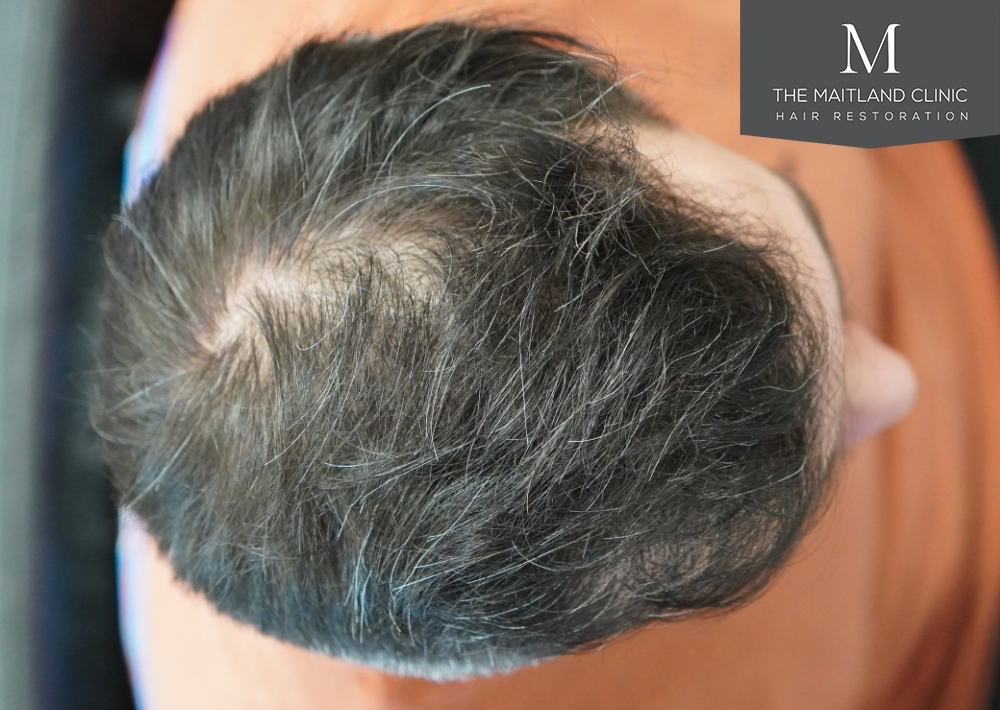 2115 grafts by FUE