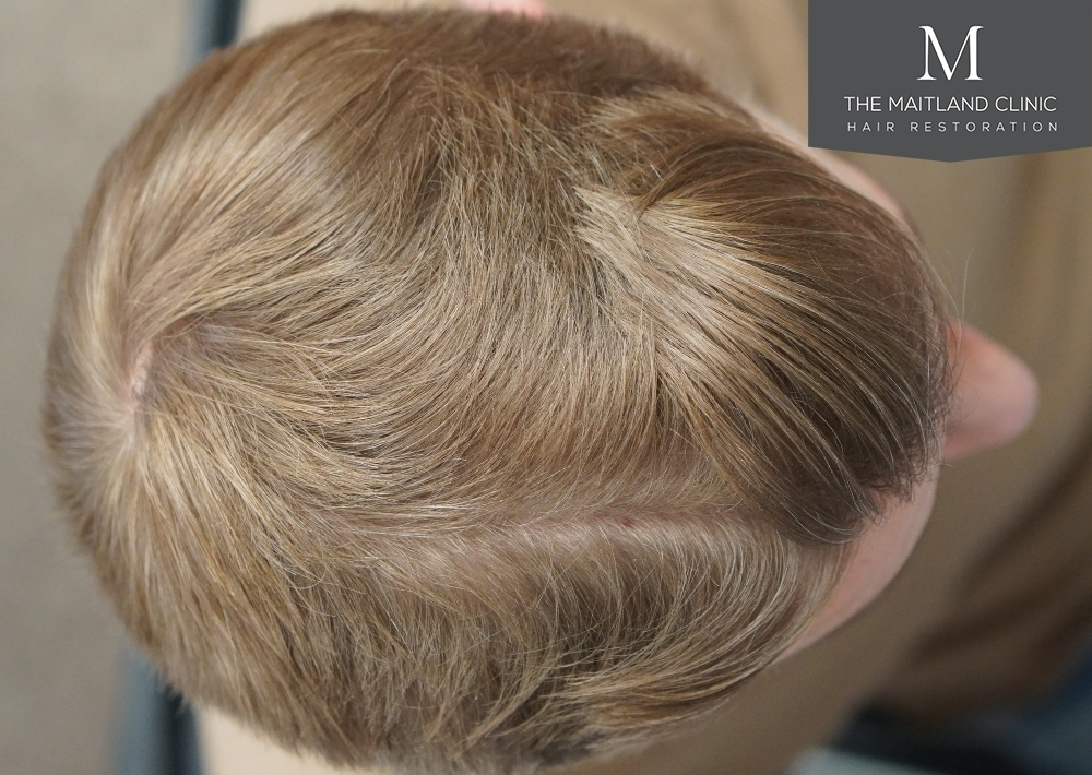 1803 grafts by FUE