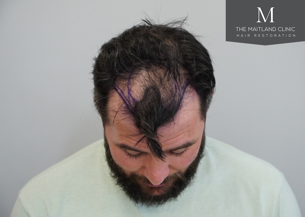 2115 grafts by FUE